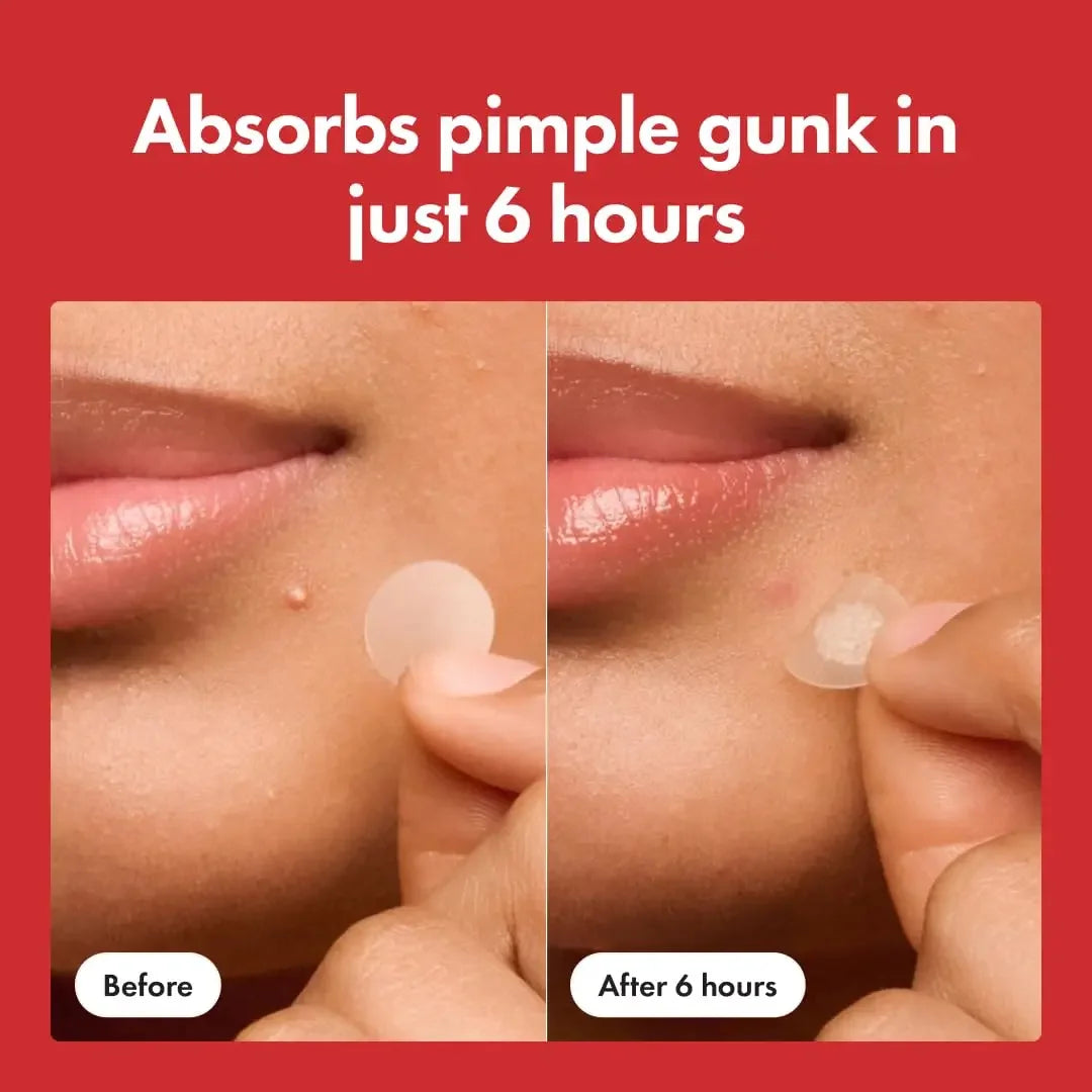 Hero Cosmetics Mighty Patch Hydrocolloid Acne Spot Treatment
